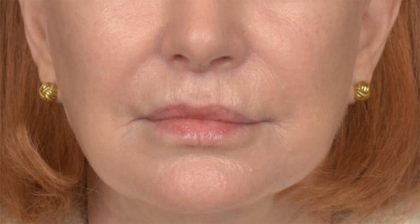Lip Lift Before & After Patient #4171