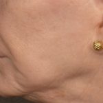 Lip Lift Before & After Patient #4171