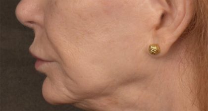 Lip Lift Before & After Patient #4171