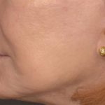Lip Lift Before & After Patient #4171