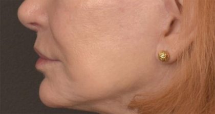 Lip Lift Before & After Patient #4171