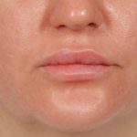 Lip Lift Before & After Patient #4172