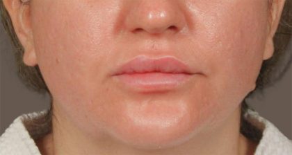 Lip Lift Before & After Patient #4172