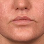Lip Lift Before & After Patient #4172