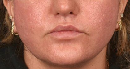 Lip Lift Before & After Patient #4172