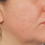 Lip Lift Before & After Patient #4172