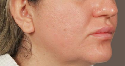 Lip Lift Before & After Patient #4172