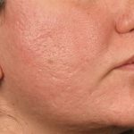 Lip Lift Before & After Patient #4172