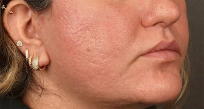 Lip Lift Before & After Patient #4172