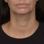 Neck Lift Before & After Patient #4233
