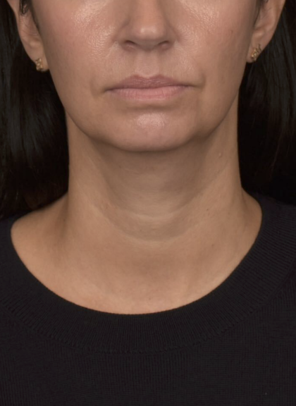 Neck Lift Before & After Patient #4233