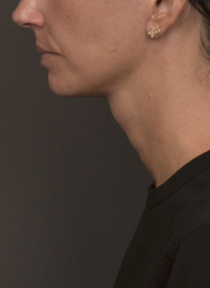 Neck Lift Before & After Patient #4233