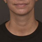 Neck Lift Before & After Patient #4233