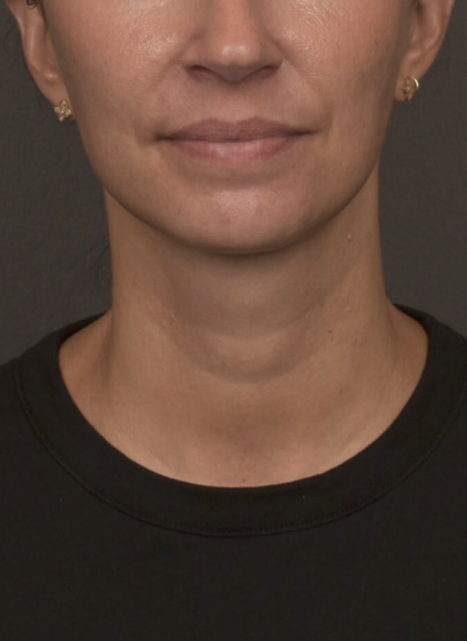 Neck Lift Before & After Patient #4233