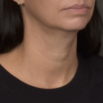 Neck Lift Before & After Patient #4233