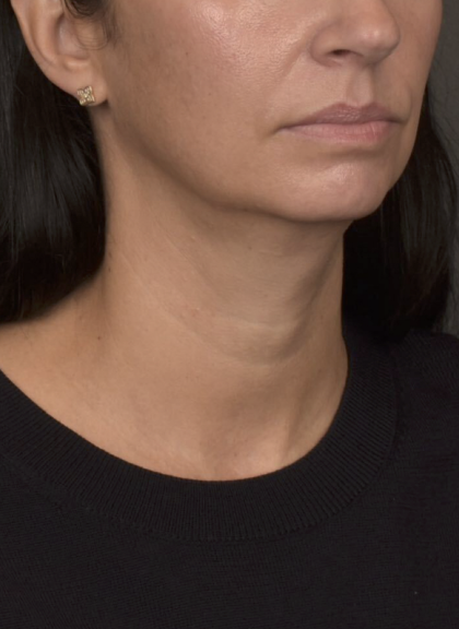 Neck Lift Before & After Patient #4233