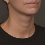 Neck Lift Before & After Patient #4233