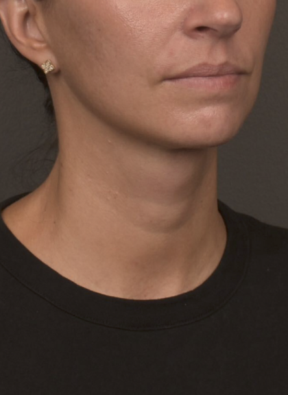 Neck Lift Before & After Patient #4233