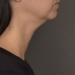 Neck Lift Before & After Patient #4233