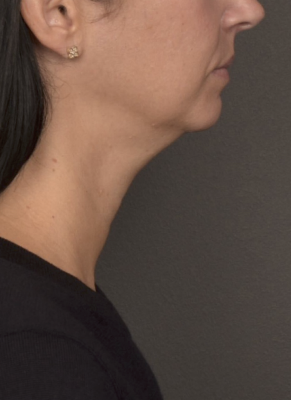 Neck Lift Before & After Patient #4233