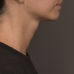 Neck Lift Before & After Patient #4233