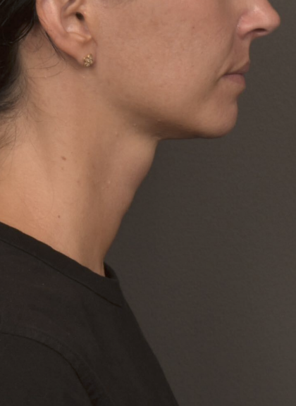 Neck Lift Before & After Patient #4233