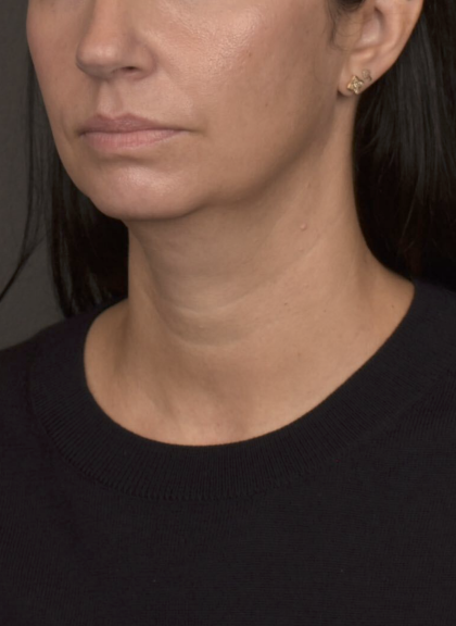 Neck Lift Before & After Patient #4233