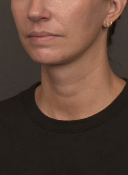 Neck Lift Before & After Patient #4233