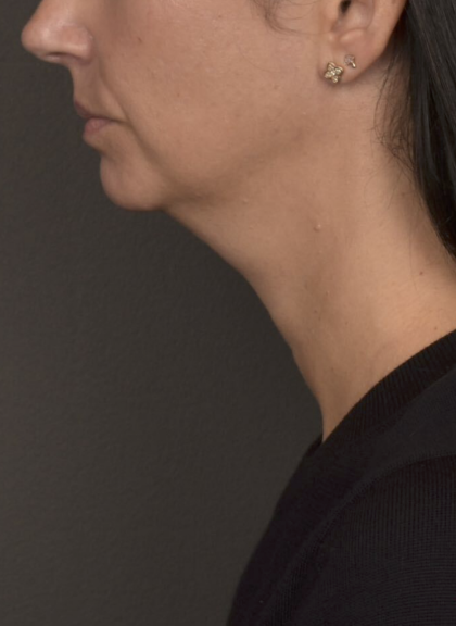 Neck Lift Before & After Patient #4233