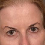 Brow Lift Before & After Patient #4267