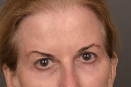 Brow Lift Before & After Patient #4267