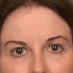 Brow Lift Before & After Patient #4267