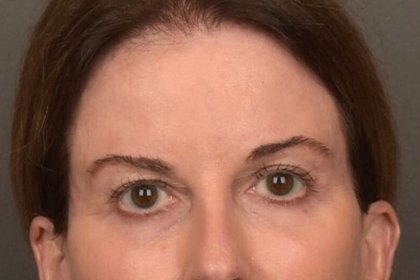 Brow Lift Before & After Patient #4267