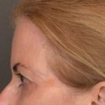 Brow Lift Before & After Patient #4267
