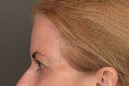 Brow Lift Before & After Patient #4267