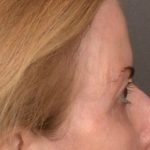 Brow Lift Before & After Patient #4267