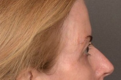 Brow Lift Before & After Patient #4267