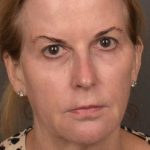 Facelift Before & After Patient #4266