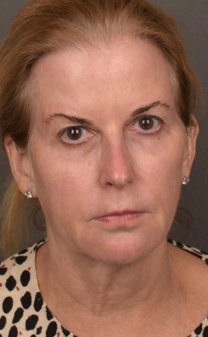 Facelift Before & After Patient #4266