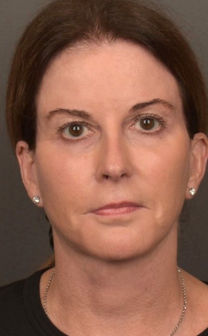 Facelift Before & After Patient #4266