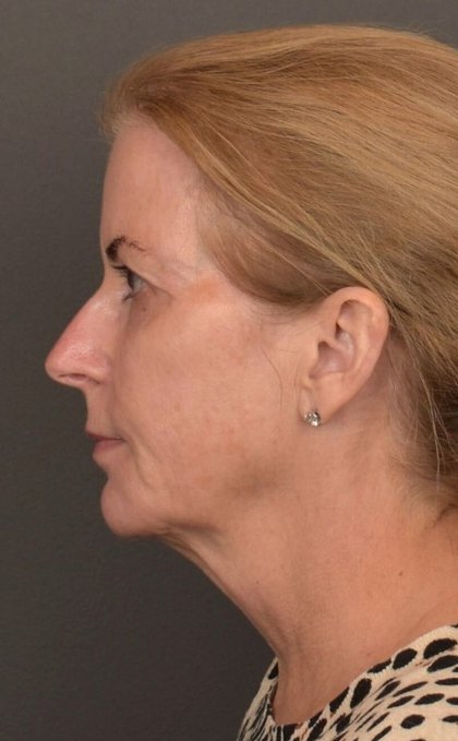 Facelift Before & After Patient #4266