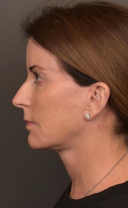 Facelift Before & After Patient #4266