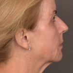 Facelift Before & After Patient #4266
