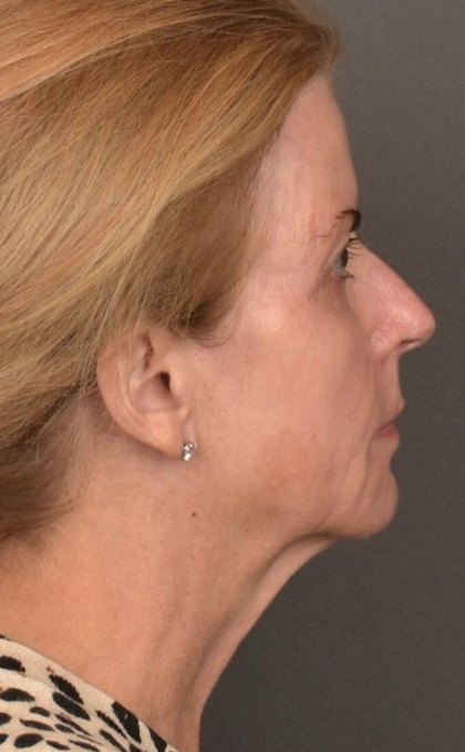 Facelift Before & After Patient #4266