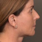 Facelift Before & After Patient #4266