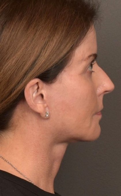 Facelift Before & After Patient #4266
