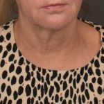 Neck Lift Before & After Patient #4268