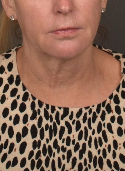 Neck Lift Before & After Patient #4268