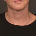 Neck Lift Before & After Patient #4268