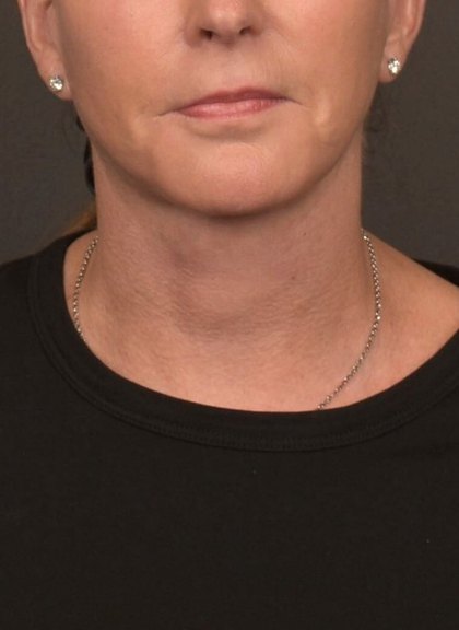 Neck Lift Before & After Patient #4268
